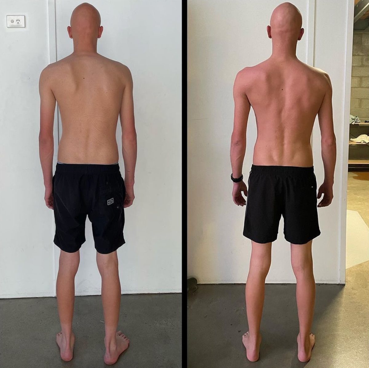 How to Correct Scapular Winging: Why Typical Exercises Often Fall Short