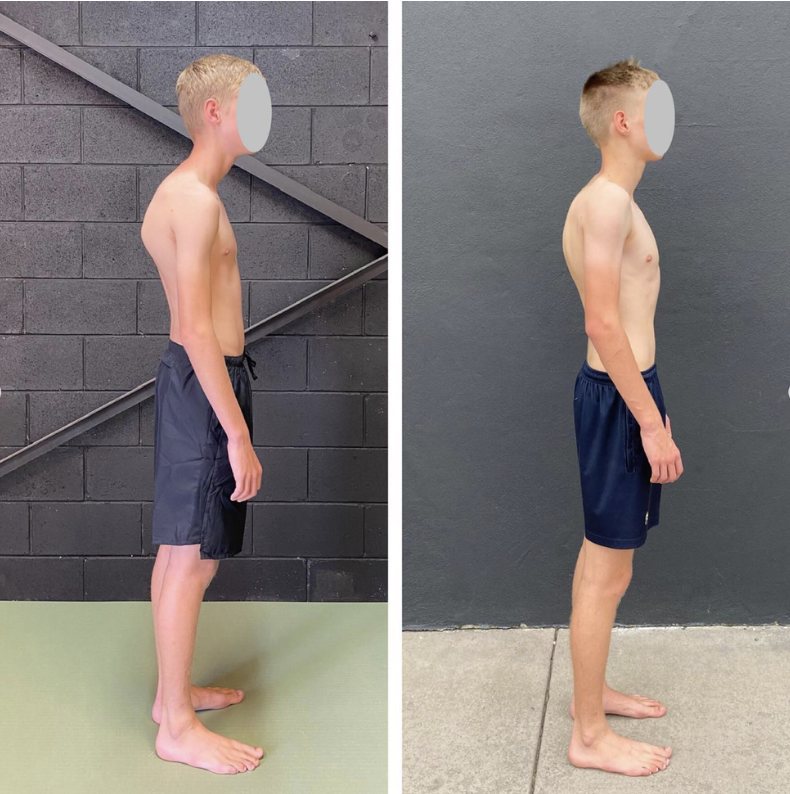 Scapular Winging Correction Functional Patterns Gold Coast