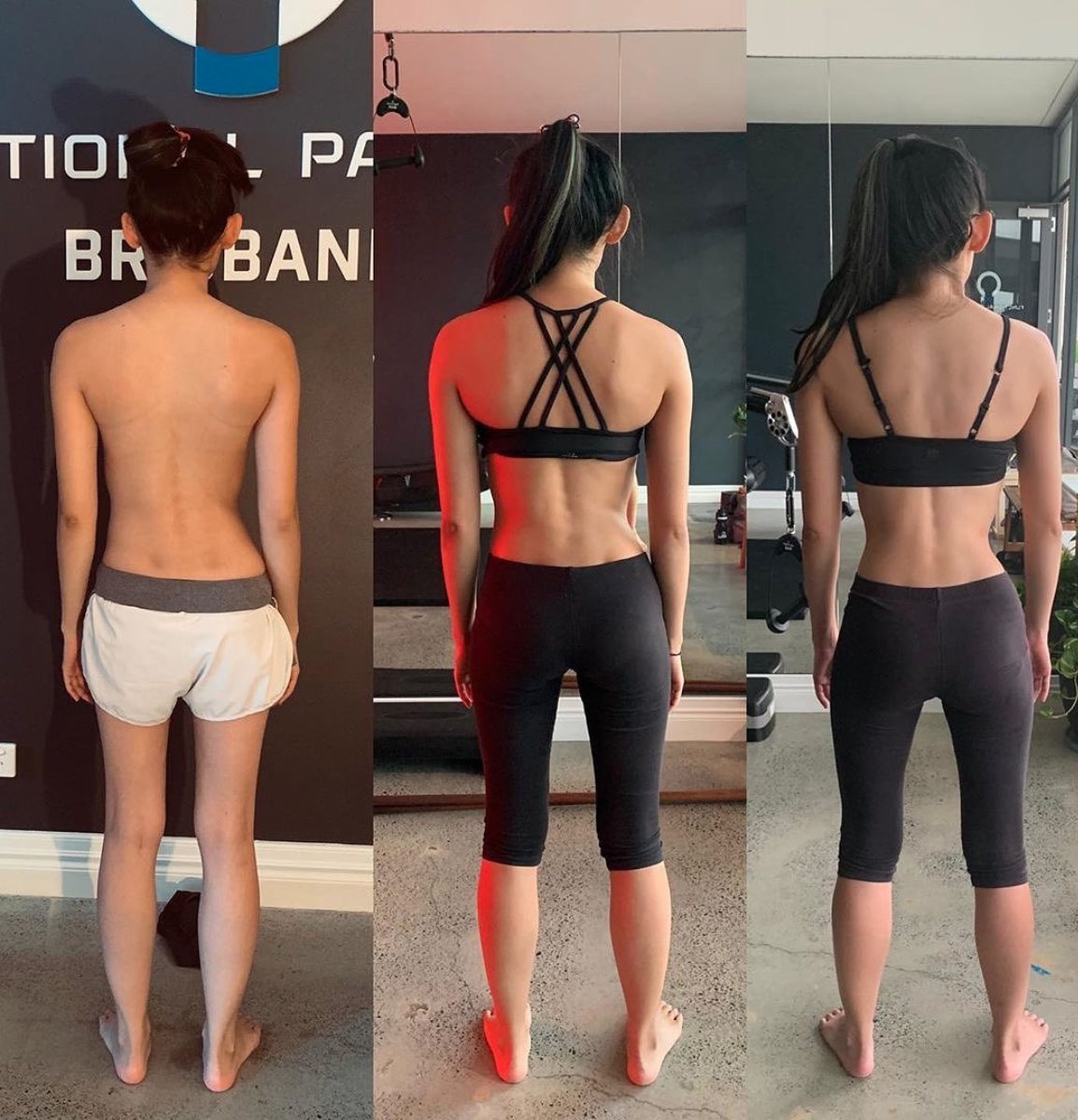 Case Studies Of Corrected Scoliosis Using Functional Patterns