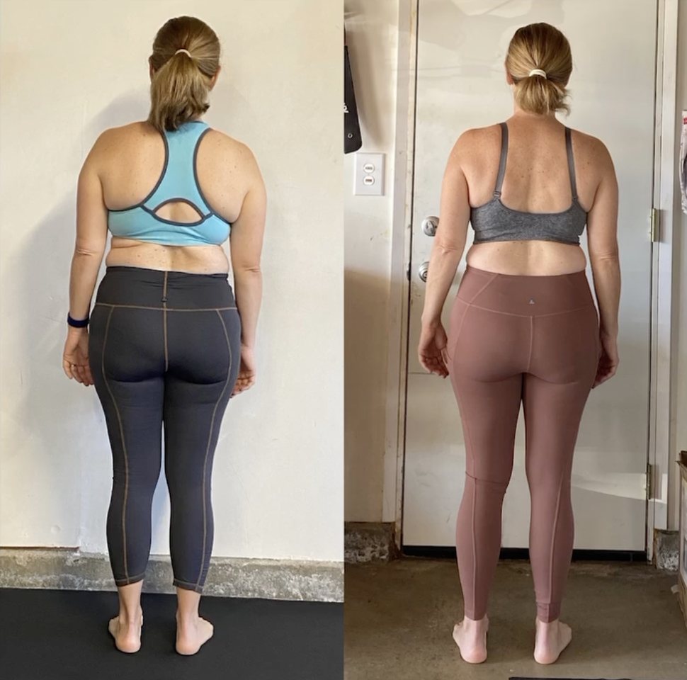 Neck Humps: Causes & Solutions Using Functional Patterns
