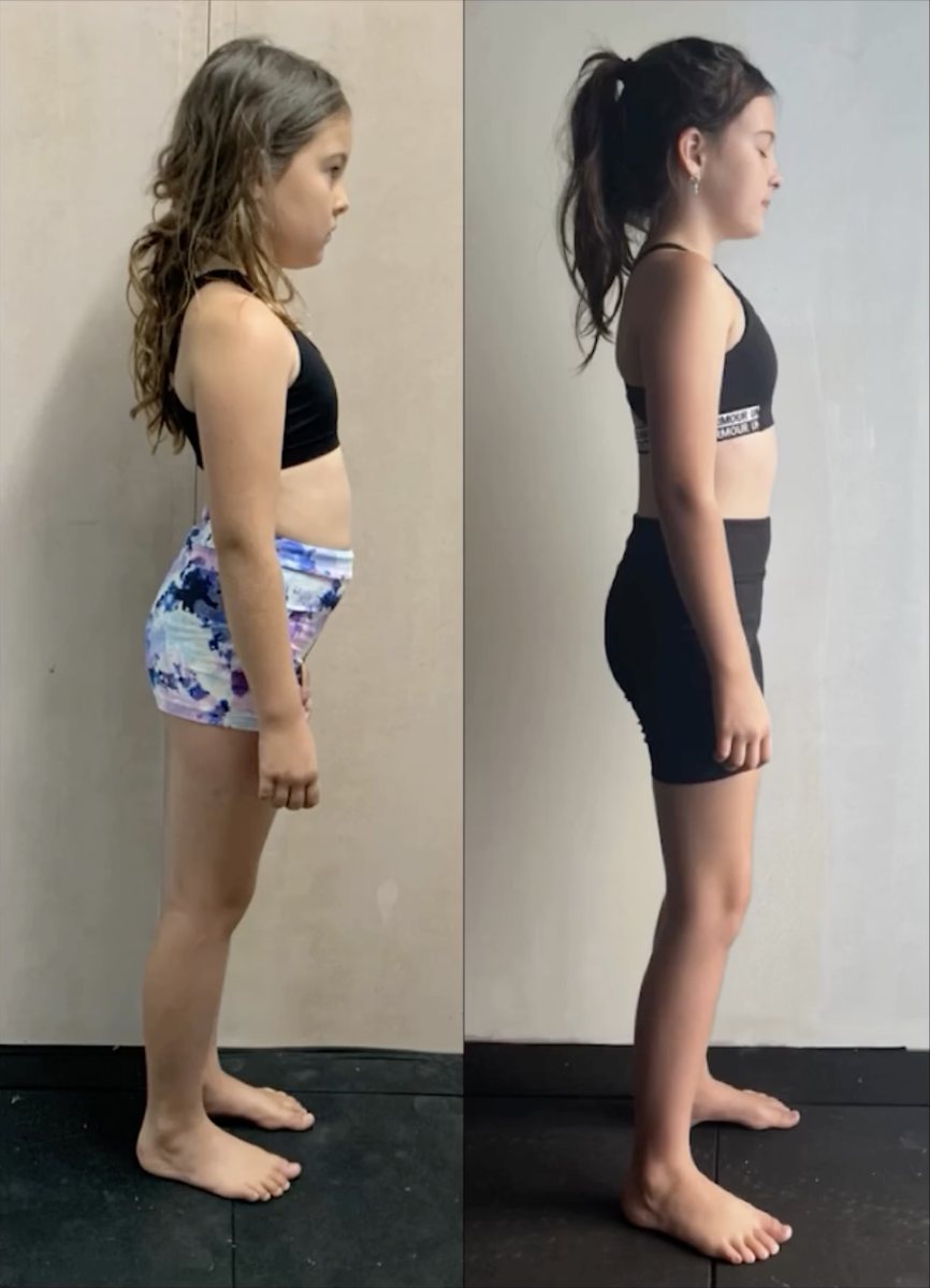 hypermobility exercise