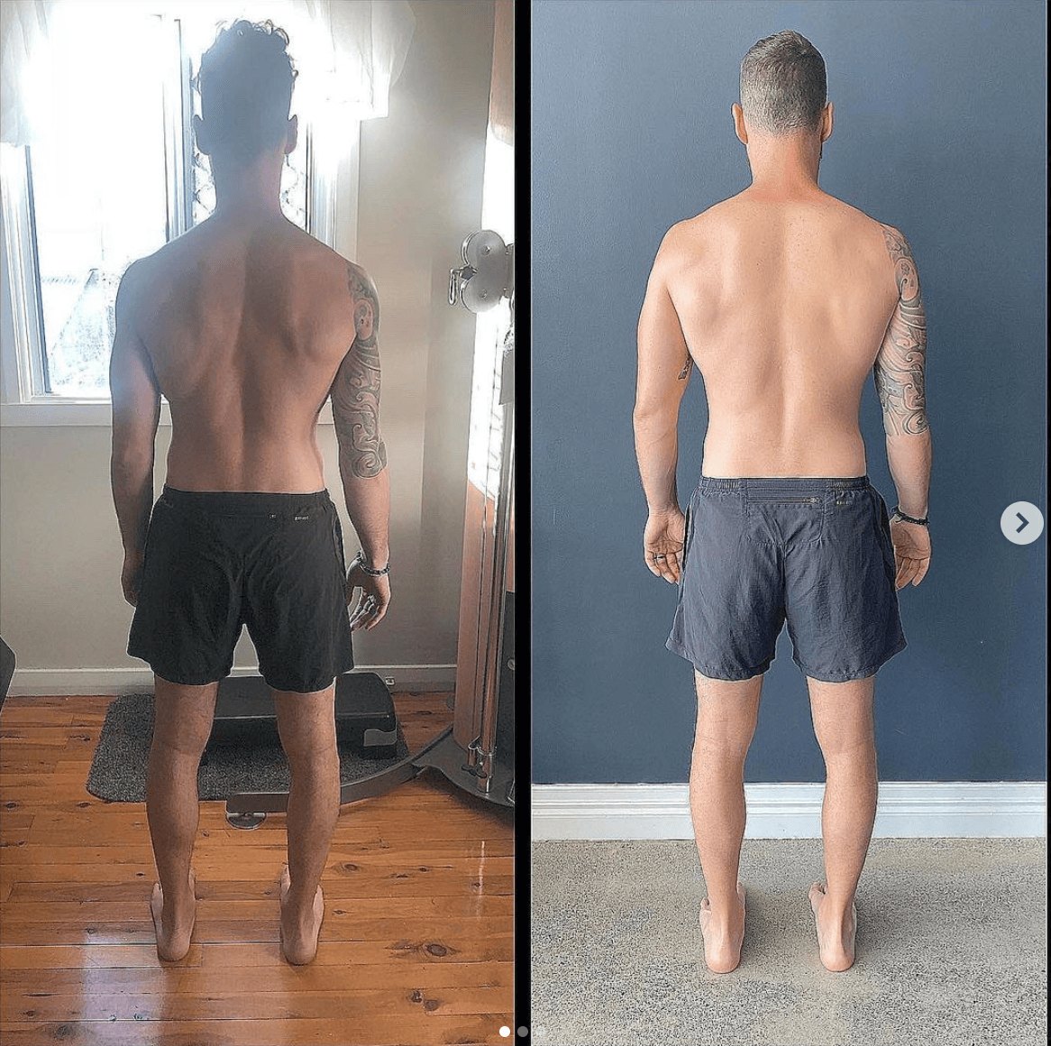 Before and after scoliosis correction at Functional Patterns Burleigh