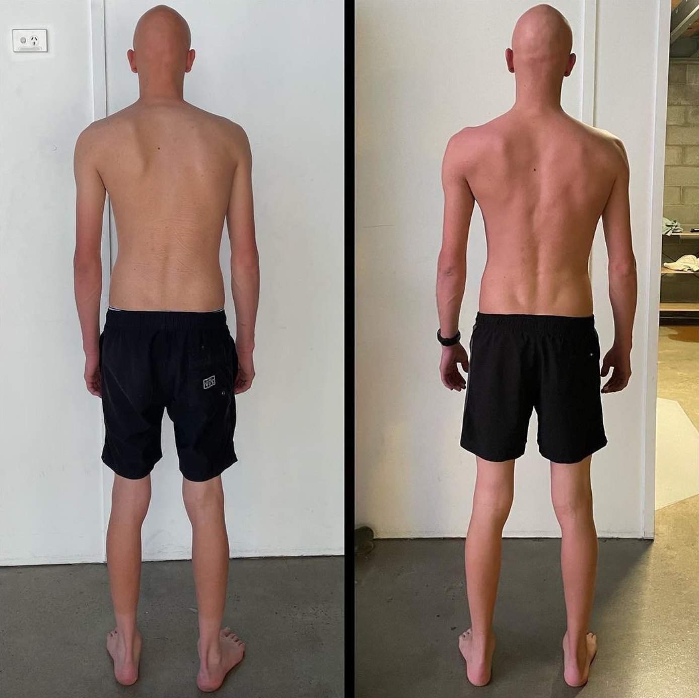 Functional Patterns posture and spine assessment on the Gold Coast