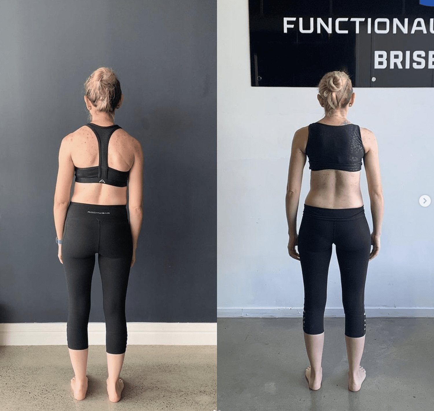 Before and after scoliosis result — Functional Patterns Burleigh