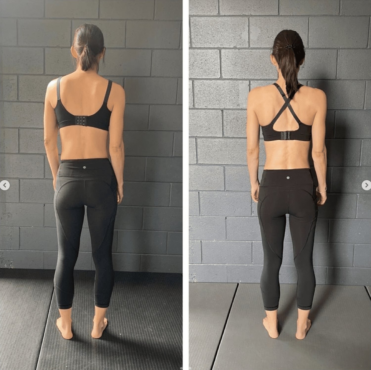 13-month scoliosis correction result — Functional Patterns Burleigh